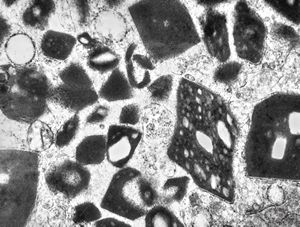 M,58y. | crystalline inclusions in hepatocyte after unknown medication M,58y. | crystalline inclusions in hepatocyte after unknown medication